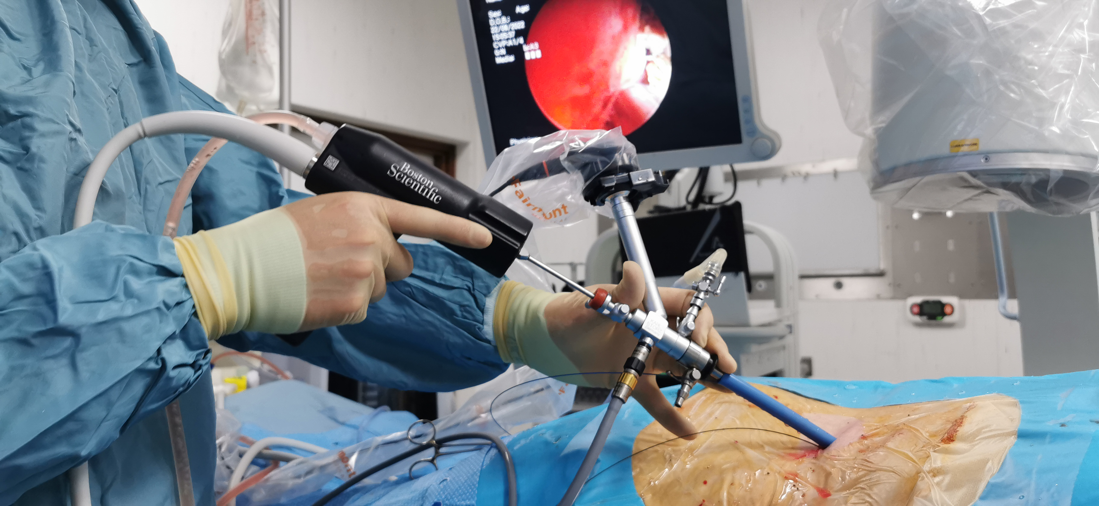 Triology lithotripsy