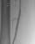 Post stent result