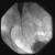 Stricture